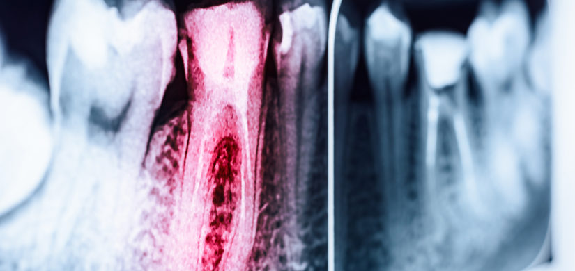Zahnerhalt und Zahnersatz